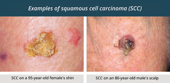 Examples of Squamous Cell Carcinoma