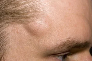 Lipoma on patient's forehead prior to excision by Dr Nathan Schaefer 