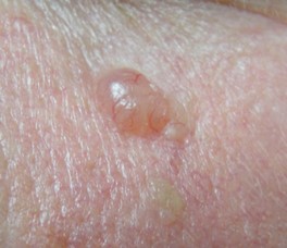 Nodular Basal cell carcinoma