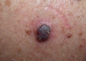 Pigmented BCC